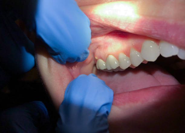 Best Emergency Wisdom Tooth Extraction in Ocean City, FL